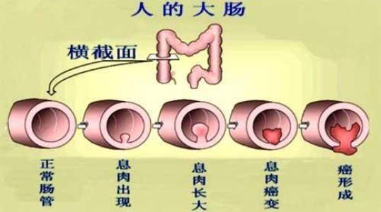 泉州治疗结肠炎需要多少费用