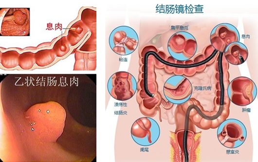 泉州直肠炎检查要多少钱